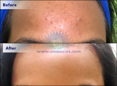 Pimple - Acne Treatment