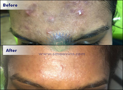 Pimple Mark Correction