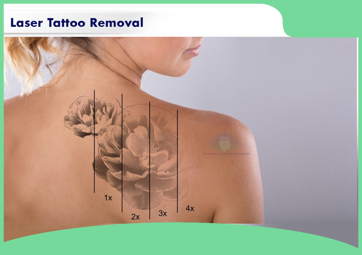 THE BEST LASER TATTOO REMOVAL NEAR ME  BEAUTYBORN MEDSPA