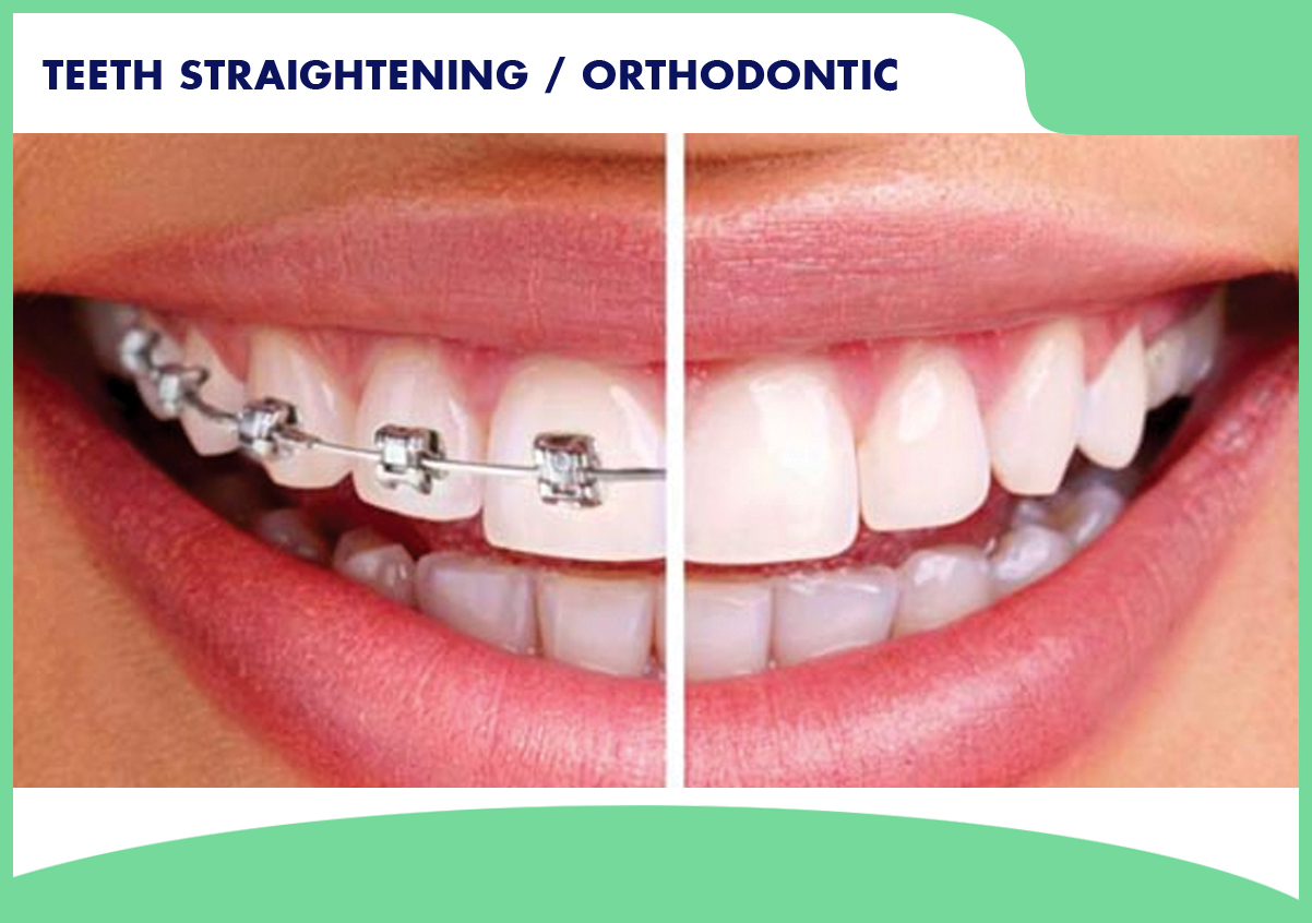 Teeth Straightening At The Best Cost Smaavins, Chennai