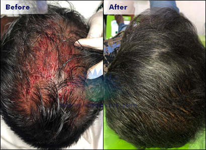 Best Hair Treatment- Hair Regrowth - Hair Implant