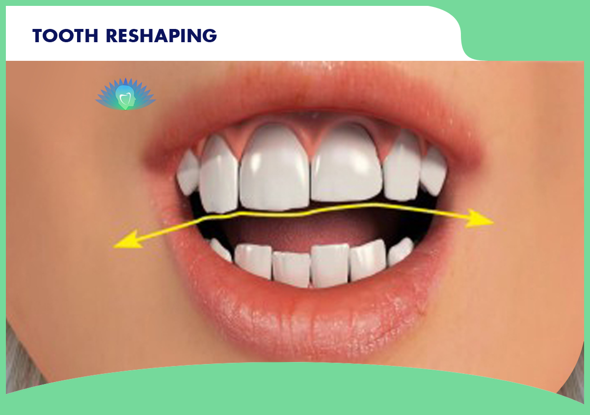 Teeth Reshaping At Smaavins Best Dental Clinic In Chennai
