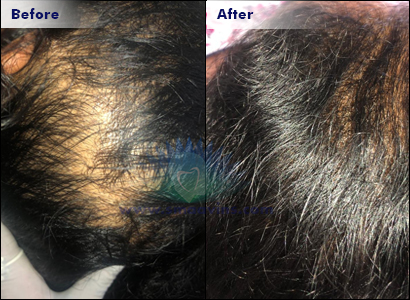 Advanced anti Hair fall Treatment in Chennai  Book Online