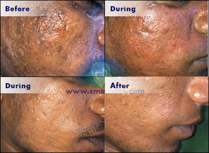 Best PRP-Skin Treatment - Click for more