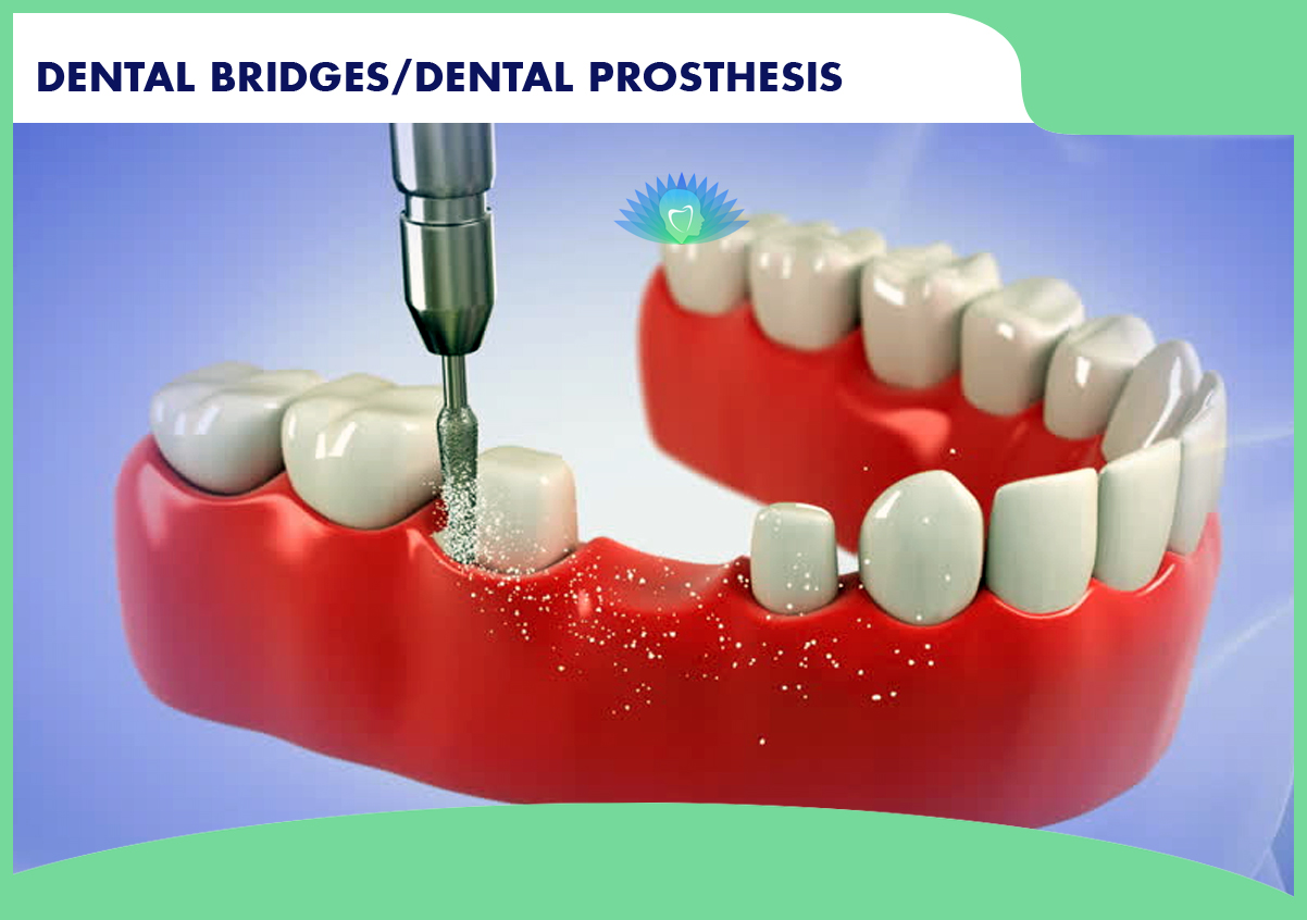 Best Dental Bridges And Dental Prosthesis Smaavins