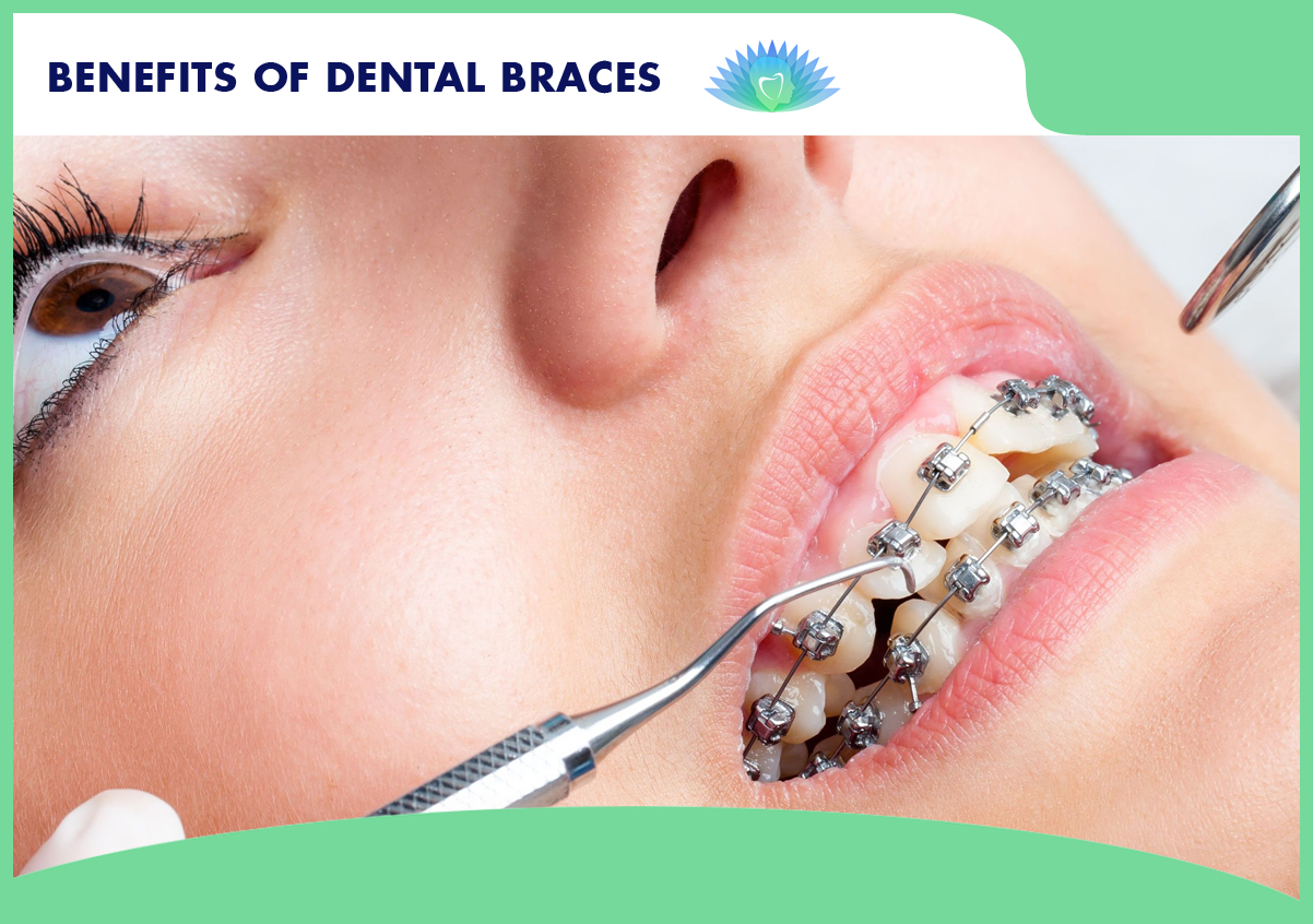 The Benefits Of Using Dental Braces Smaavins, Chennai