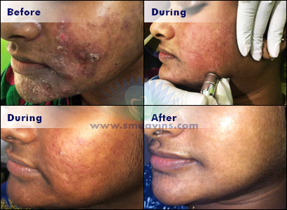 Best Skin Whitening Treatment - Click for more