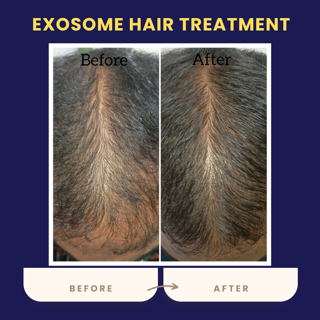 exosome-hair-treatment