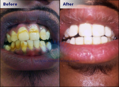 Best Dental Whitening