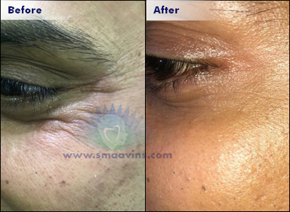 Anti Aging - Anti Wrinkle Treatment -Click Here to View Gallery