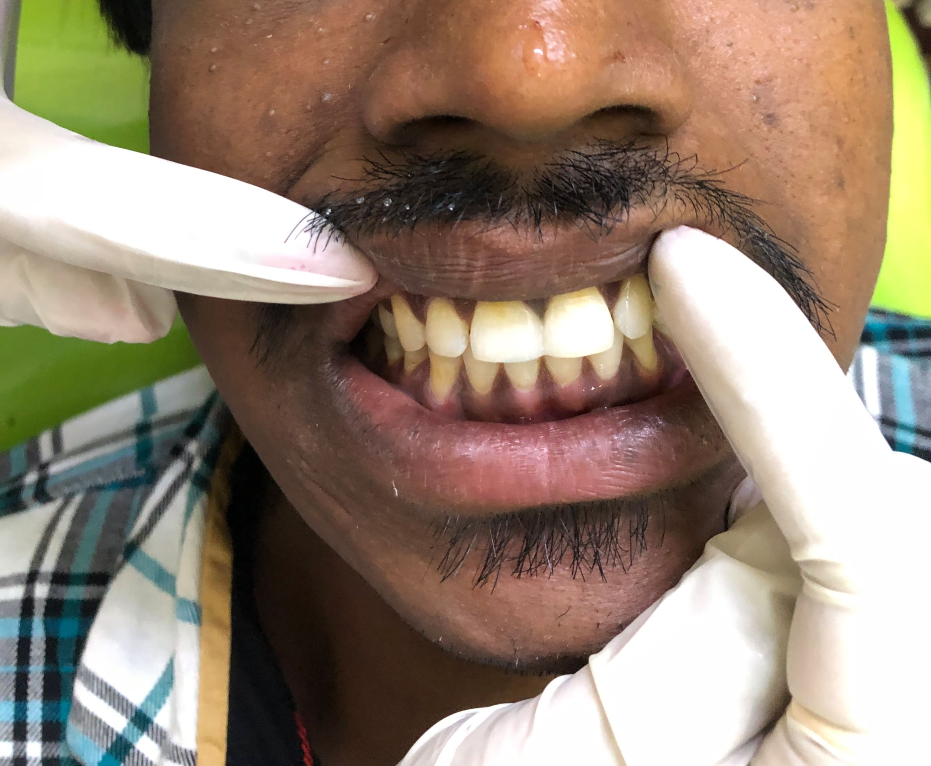COSMETIC GAP CORRECTION IN THE FRONT TEETH