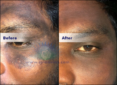 Pigmentation-Scar Removal - Click for more